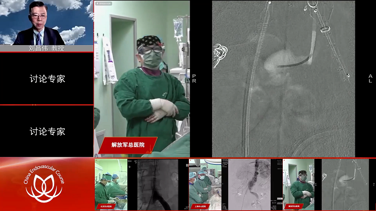 301医院&mdash;腹主动脉瘤手术直播