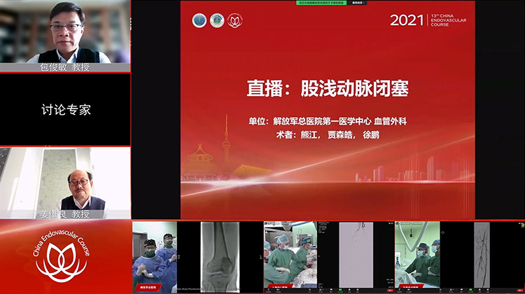 301医院&mdash;股浅动脉闭塞