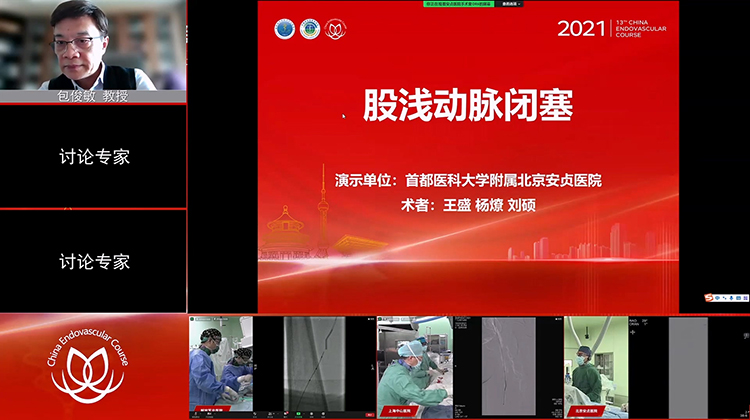 安贞医院&mdash;股浅动脉闭塞