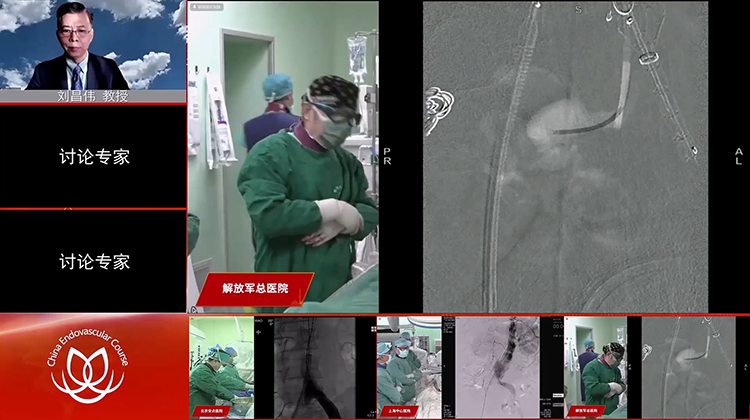 301医院&mdash;腹主动脉瘤病例手术演示