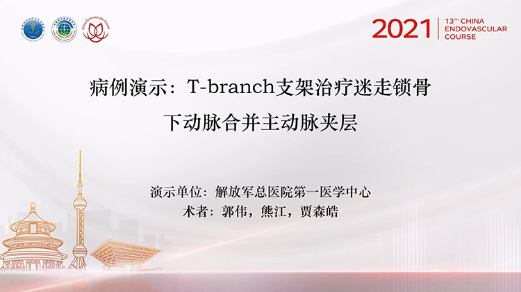 301医院&mdash;T-branch支架治疗迷走锁骨下动脉合并主动脉夹层