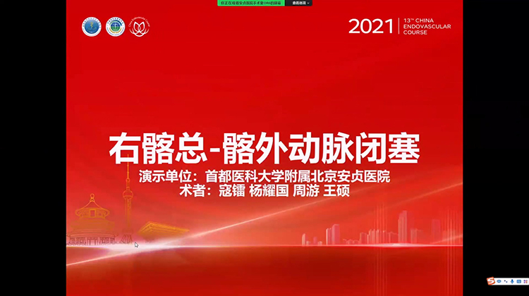 安贞医院&mdash;右髂总-髂外动脉闭塞
