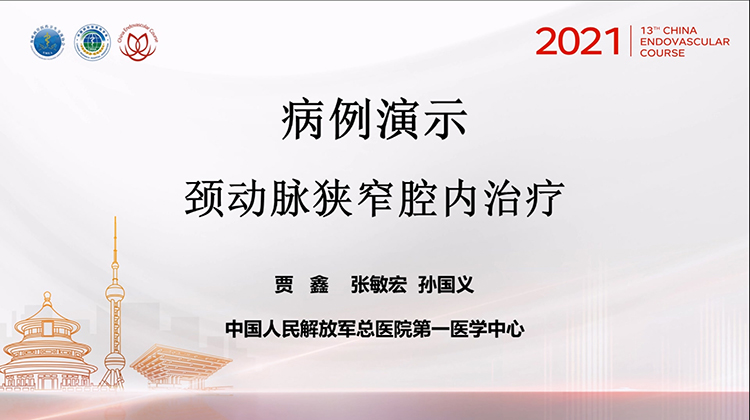 301医院&mdash;颈动脉狭窄腔内治疗