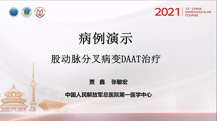 301医院&mdash;股动脉分叉病变DAAT治疗