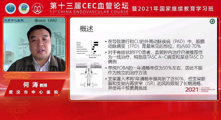 DCB在PAD腔内治疗中的地位-何涛
