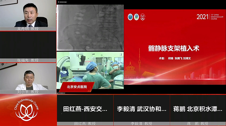 安贞医院&mdash;髂静脉支架植入术