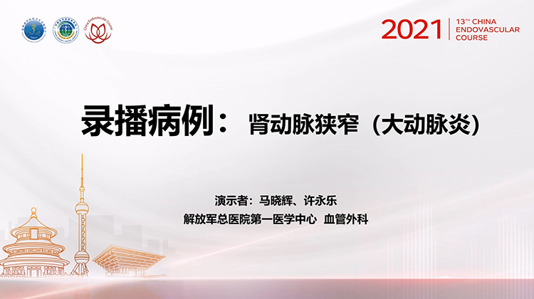 301医院&mdash;肾动脉狭窄（大动脉炎）