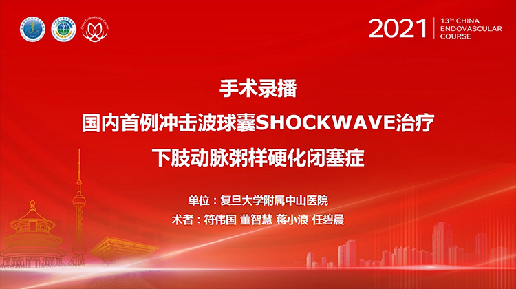复旦中山&mdash;国内首例冲击波球囊SHOCKWAVE治疗下肢动脉粥样硬化闭塞症