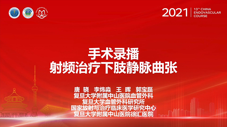 复旦中山&mdash;射频治疗下肢静脉曲张