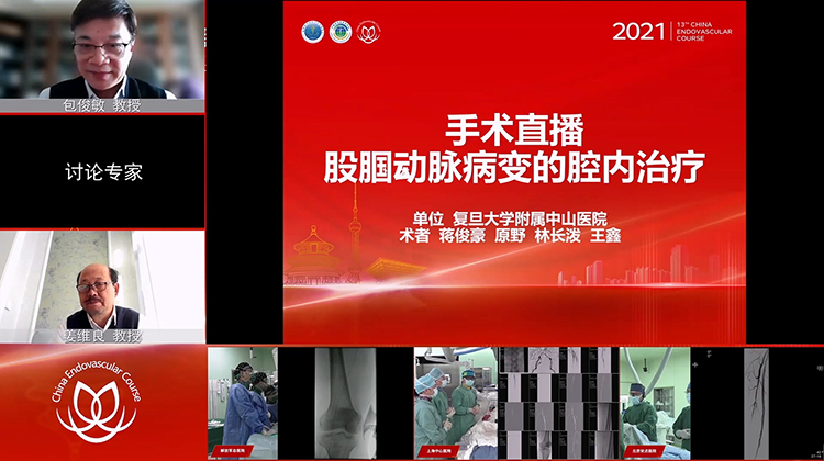 复旦中山&mdash;股腘动脉病变的腔内治疗
