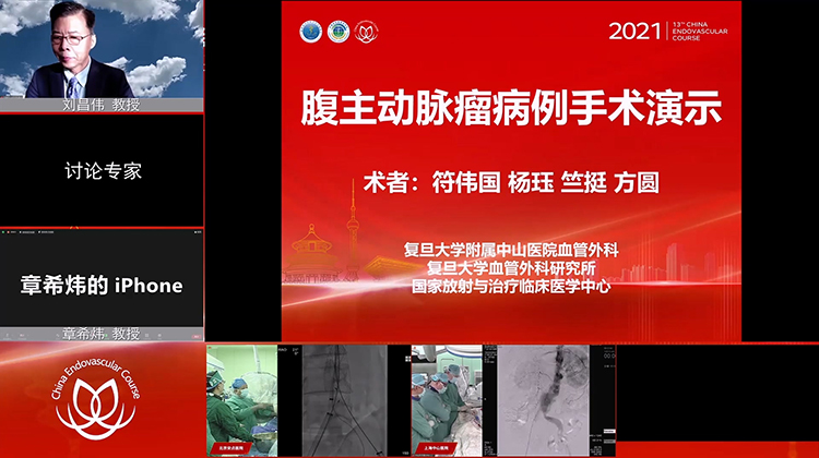 复旦中山&mdash;腹主动脉瘤病例手术演示