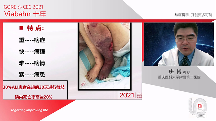 Viabahn在联合腔内介入治疗急性下肢动脉缺血中的应用体会-唐博