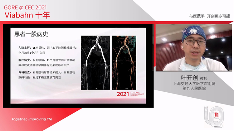 Viabahn重建髂动脉支架内再狭窄病例分享-叶开创