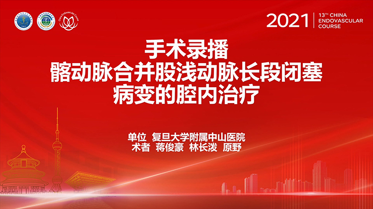 复旦中山&mdash;髂动脉合并股浅动脉长段闭塞病变的腔内治疗