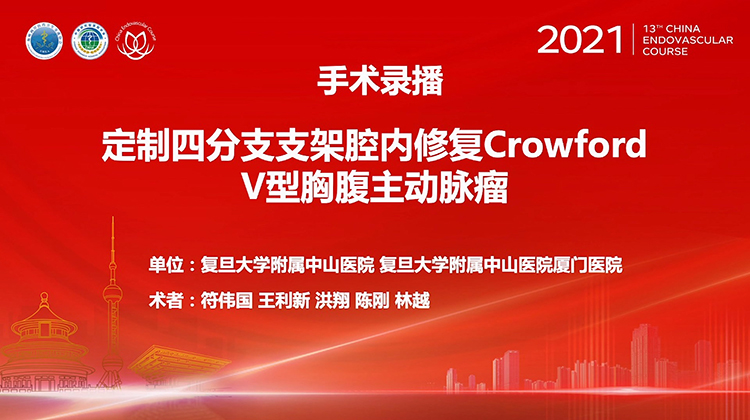 复旦中山&mdash;定制四分支支架腔内修复Crowford V型胸腹主动脉瘤