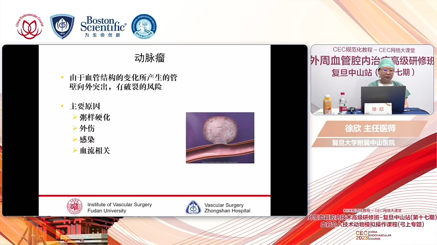 动脉瘤-徐欣