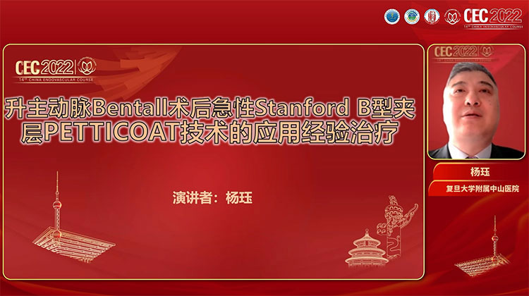 升主动脉Bentall术后急性Stanford B型夹层PETTICOAT技术的应用经验治疗-杨珏