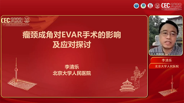 瘤颈成角对EVAR手术的影响及应对探讨 李清乐