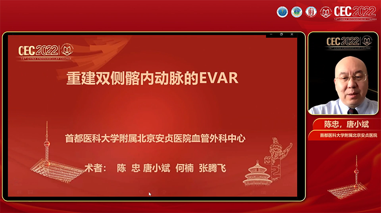重建双侧髂内动脉的EVAR-陈忠 唐小斌