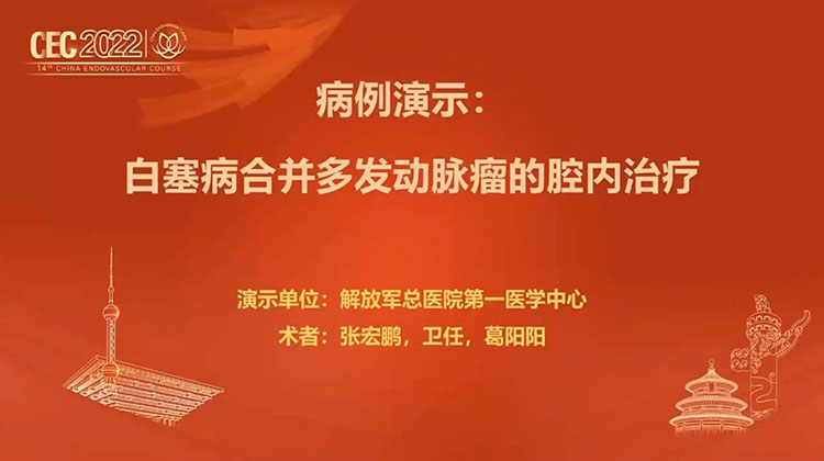 白塞病合并多发动脉瘤的腔内治疗-张宏鹏