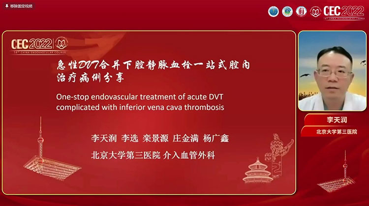 急性DVT合并下腔静脉血栓一站式腔内治疗病例分享-李天润