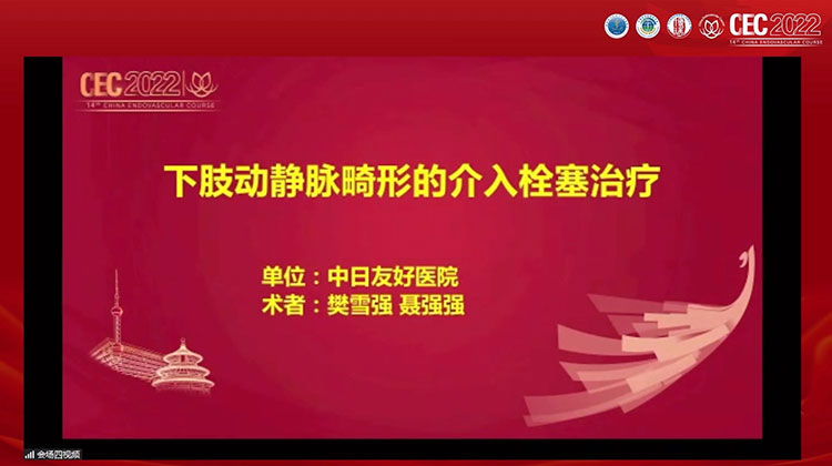 下肢动静脉畸形的介入栓塞治疗-樊雪强