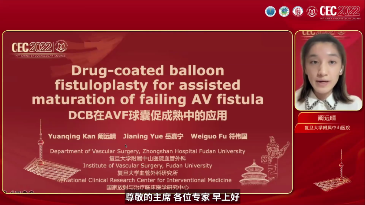 Drug-coated balloon fistuloplasty for assisted maturation of failing AV fistula-阚远晴