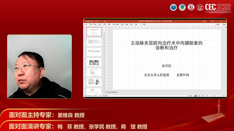 主动脉夹层腔内治疗术中内膜脱套的诊断和治疗-张学民