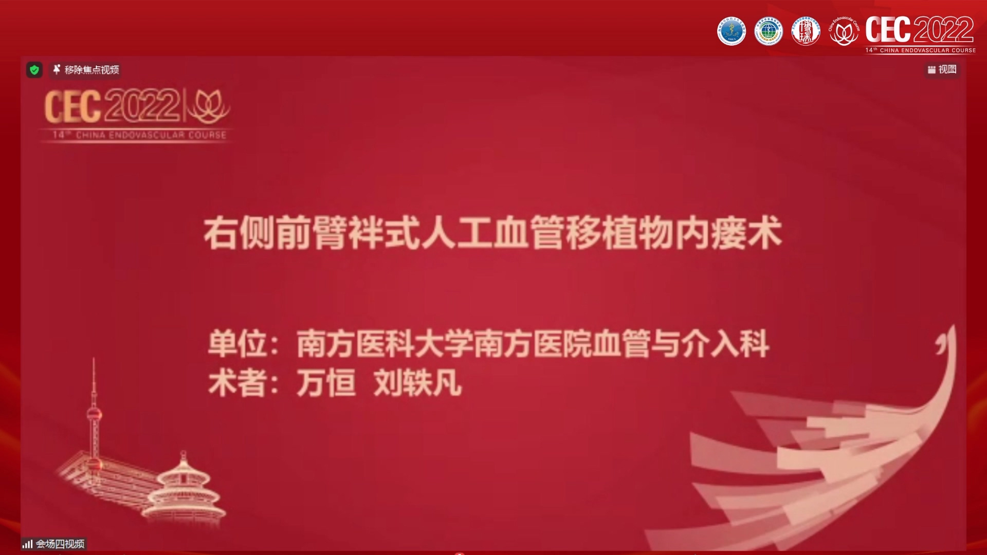 右侧前臂袢式人工血管移植物内瘘术-万恒