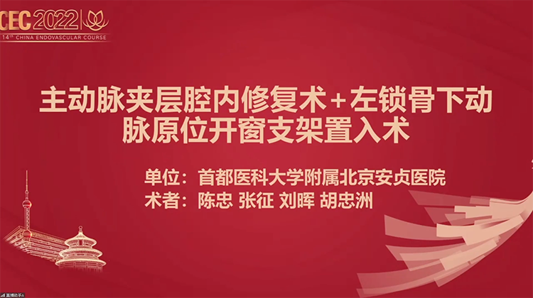 主动脉夹层腔内修复术+左锁骨下动脉原位开窗支架置入术-陈忠 张征