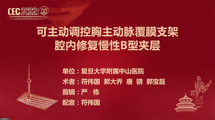 可主动调控胸主动脉覆膜支架腔内修复慢性B型夹层- 符伟国 郭大乔