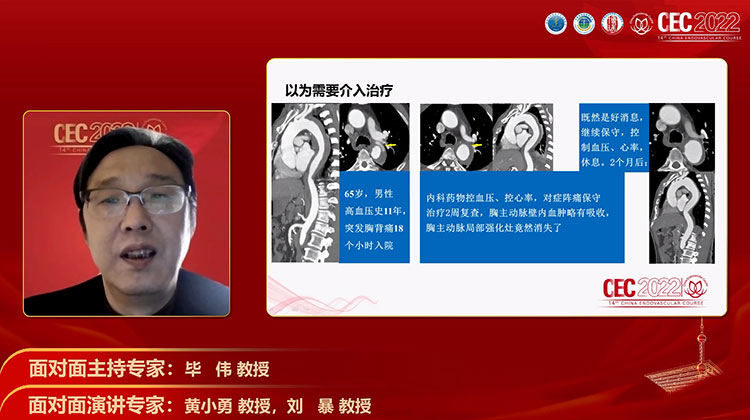 主动脉壁内血肿影像及治疗经验探讨-黄小勇