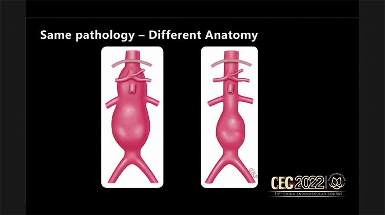 Classification-systems-for-Deep-Venous-Disease-Tony-Gasparis