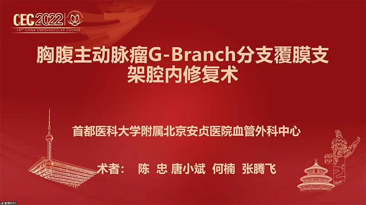 胸腹主动脉瘤G-Branch分支覆膜修复术-陈忠 唐小斌
