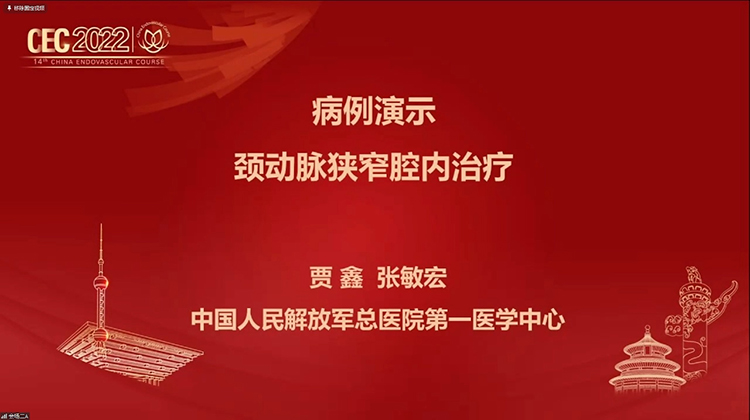 病例演示：颈动脉腔内治疗-贾鑫 张敏宏