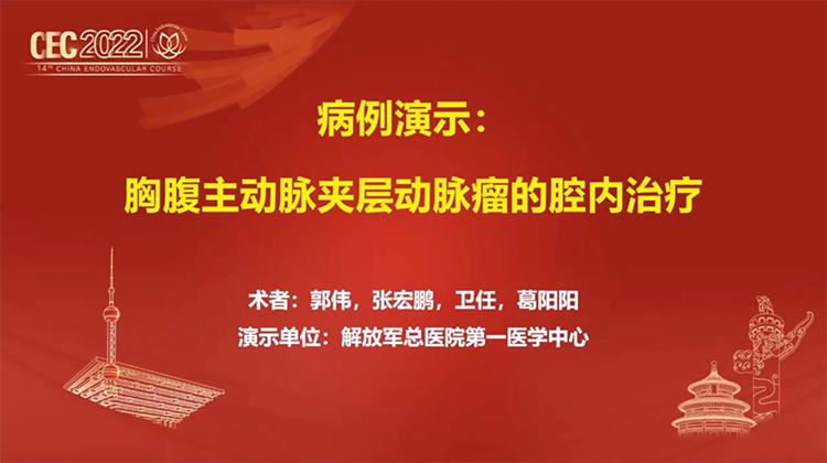胸腹主动脉夹层动脉瘤的腔内治疗-郭伟 张宏鹏