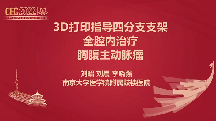 3D打印指导分支支架全腔内治疗胸腹动脉瘤-李晓强