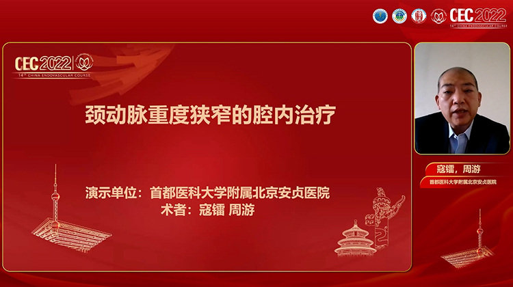 颈动脉重度狭窄的腔内治疗-寇镭 周游