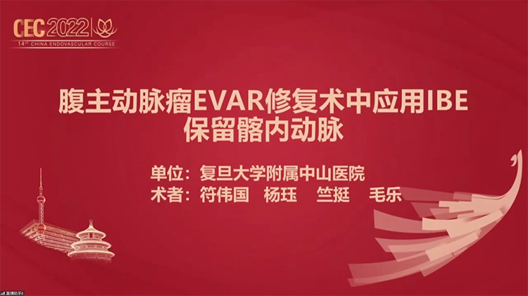 腹主动脉瘤EVAR修复术中应用IBE保留髂内动脉-符伟国 杨珏 竺挺