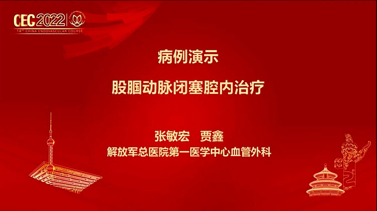 股腘动脉病变的腔内治疗-贾鑫-张敏宏
