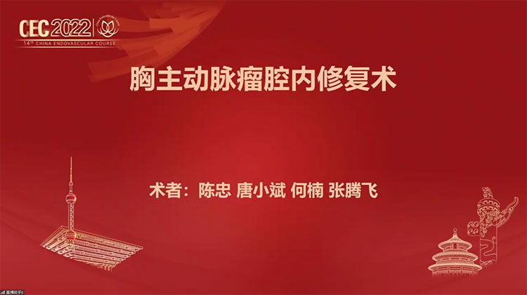 胸主动脉瘤腔内修复术-陈忠，唐小斌