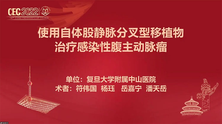 使用自体股静脉分叉型移植物治疗感染性动脉瘤-岳嘉宁-杨珏