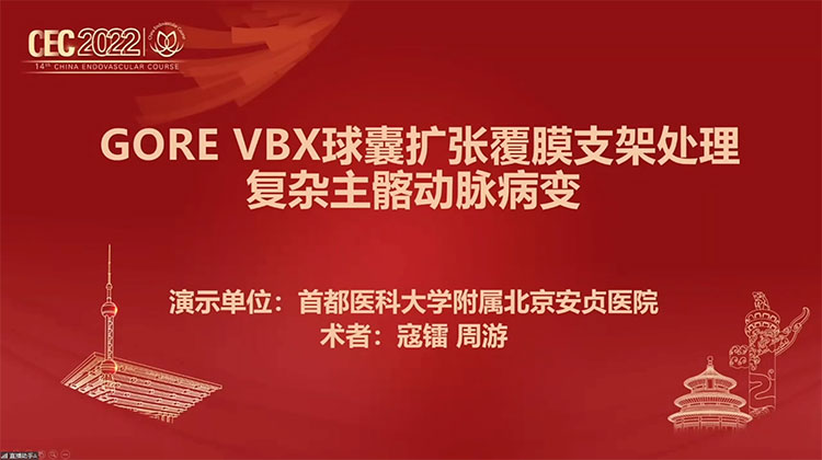 手术演示：GORE VBX球囊扩张覆膜支架治疗复杂主髂动脉病变-寇镭，周游 