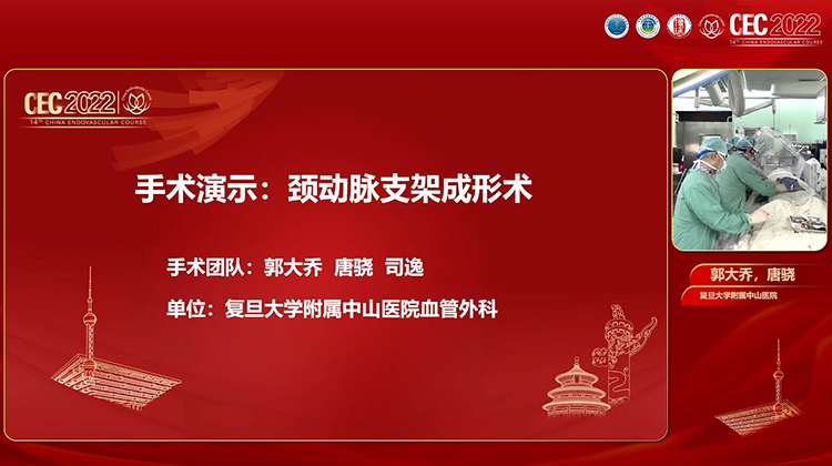 手术演示：颈动脉支架成形术-郭大乔 唐骁