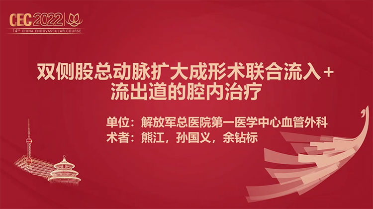 双侧股总动脉扩大成形术联合流入＋流出道的腔内治疗-熊江，孙国义 