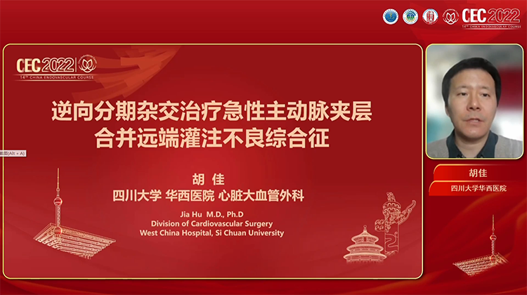 逆向分期杂交治疗急性主动脉夹层合并远端灌注不良综合症-胡佳