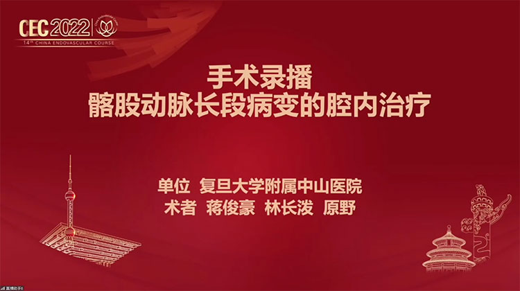 髂股动脉长段病变的腔内治疗-蒋俊豪，林长泼
