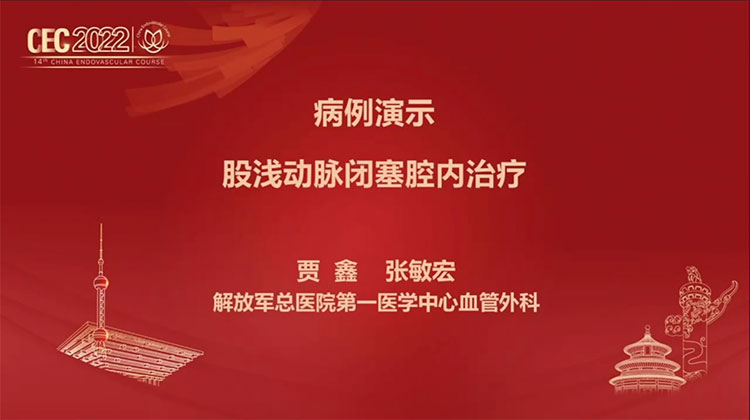 病例演示：股浅动脉闭塞腔内治疗-贾鑫，张敏宏