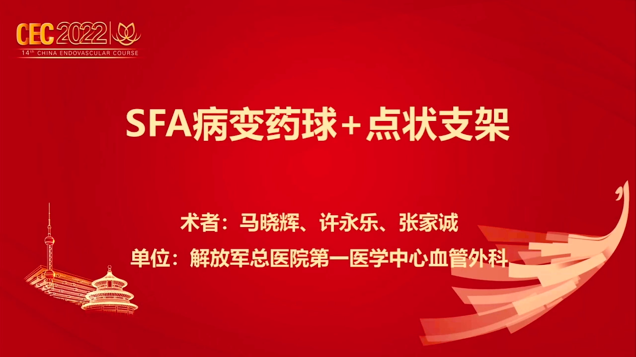 SFA病变药球+点状支架-马晓辉