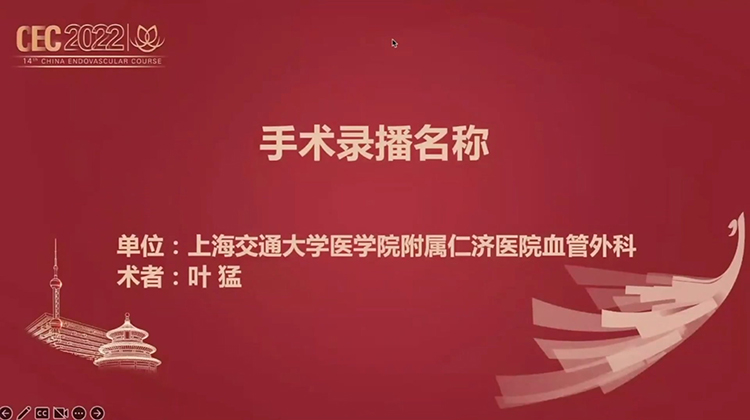 膝下动脉开通手术-叶猛